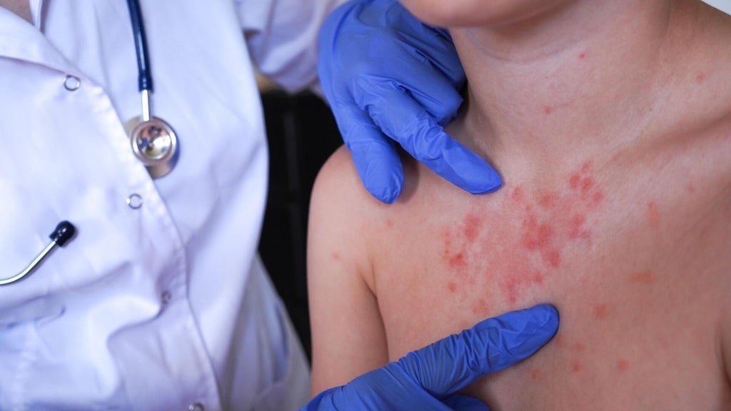 Minnesota's 80 measles cases this year are the most since 1990, health officials say — Maple Grove Health news
