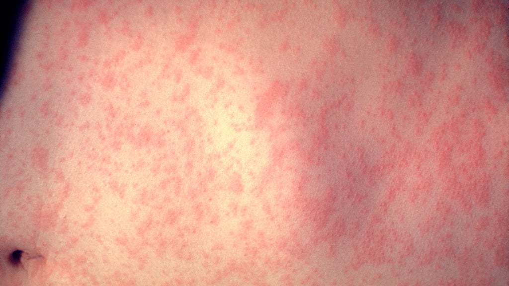 25 cases of measles identified in central, southeastern Minnesota, MDH says — WCCO / CBS Minnesota, Maple Grove Health news